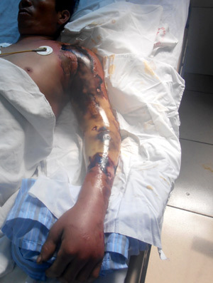 vi rút ăn thịt người; viện nhiệt đới