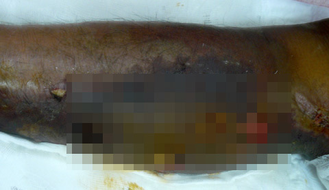 vi rút ăn thịt người; viện nhiệt đới